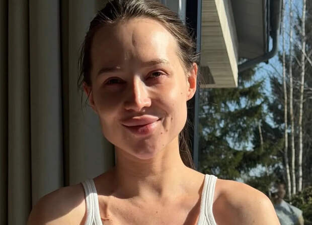 «Вопрос времени»: адвокат онкобольной Лерчек отреагировал на слухи о ее «лжеболезни»