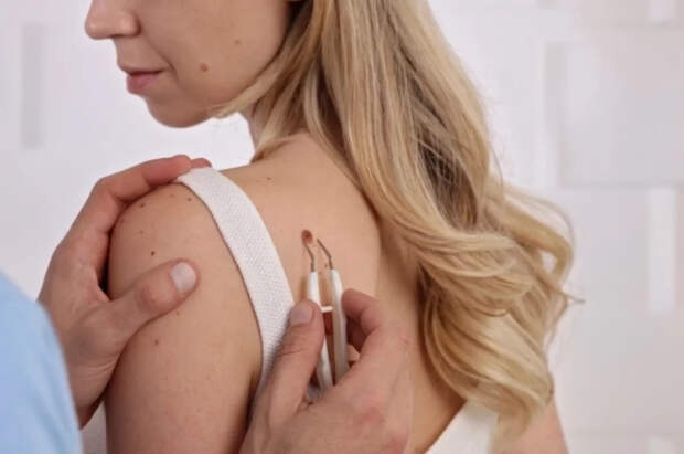 Эксперт оценила вероятность развития рака кожи после повреждения родинки