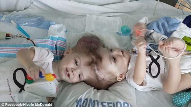 Первые фотографии сиамских близнецов после разделения медицина, сиамские близнецы, хирургия