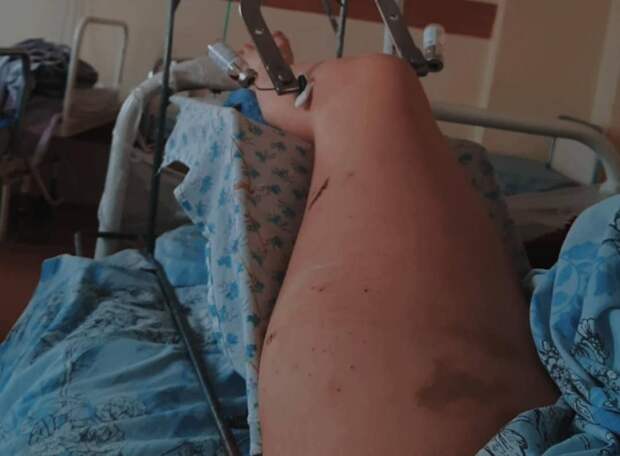 В Ставропольском крае  ночью с 10 на 11 марта произошла авария в Ессентуках. Машина «скорой» припарковалась у обочины с включёнными маячками. 22-летняя фельдшер Алина Афанасиади оказывала помощь пациенту на улице. Мимо ехал по городу водитель ВАЗ. Он превысил скорость, не справился с управлением, сбил медработника и въехал в машину скорой помощи. В больницу также доставлены 29-летний водитель и 18-летний пассажир автомобиля ВАЗ. У водителя взяли анализ на установление алкоголя в крови.
