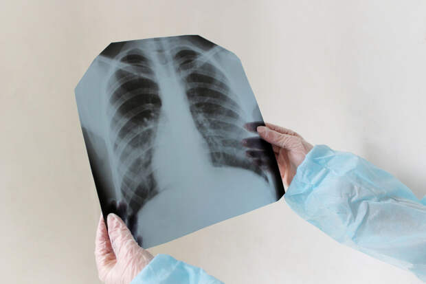 "Mash на Мойке": у преподавателя СПбГУ обнаружили туберкулез