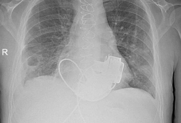 Уникального пациента без пульса выпишут из российской больницы