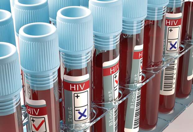 HIV AIDS blood test