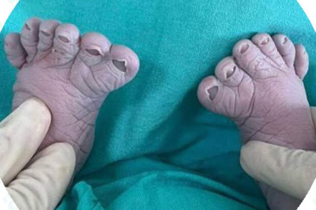 Жительница Уфы родила третьего ребенка с 12 пальцами на ногах