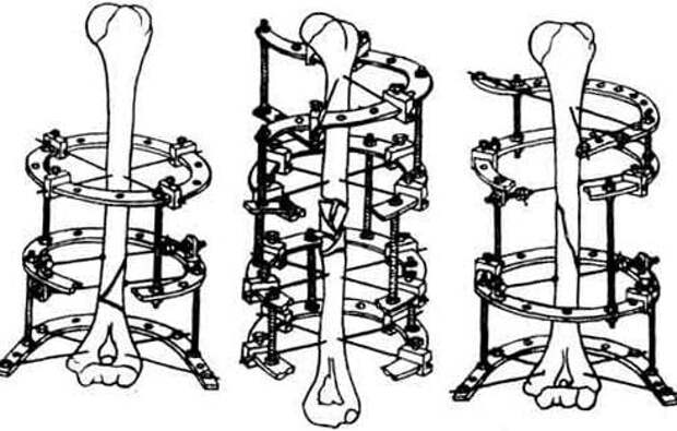 Аппарат илизарова рисунок