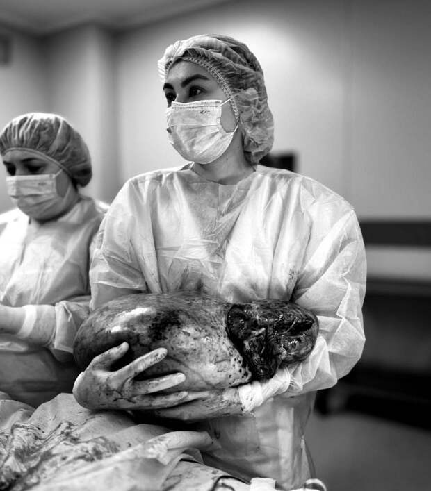 В ГАУЗ «Областная детская клиническая больница» поступила девочка с диагнозом гигантская муцинозная цистаденома яичника. Пациентка жаловалась на сильные тянущие боли внизу живота, возникшие после физической нагрузки, а также возникновение чувства распирания в положении лёжа на животе. В больнице ей экстренно сделали УЗИ и МРТ с контрастным усилением. Согласно данным исследований, у пациентки было обнаружено гигантское образование размерами 35х24х16 см, которое занимало всю брюшную полость и давило на соседние органы. В результате у девочки развился гидронефроз правой почки.