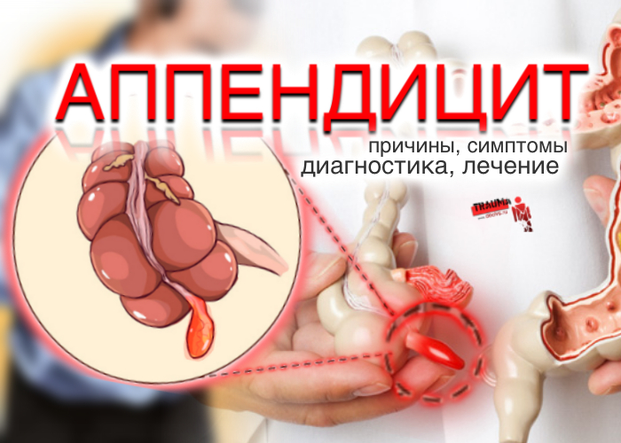 Аппендицит: причины, симптомы, диагностика, лечение