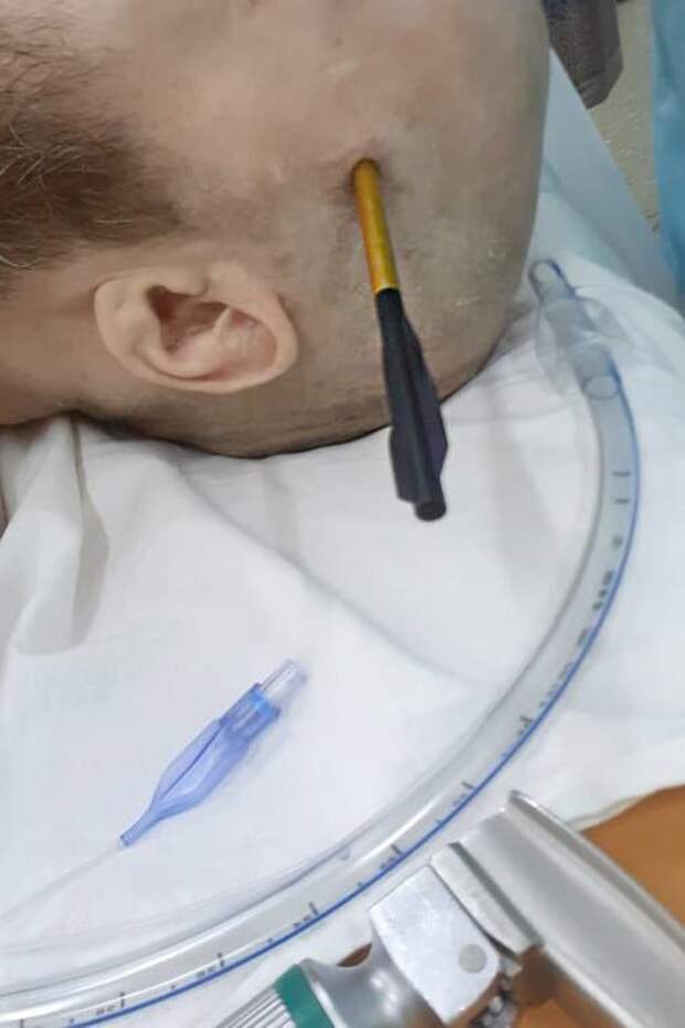 В Солнечногорскую областную больницу поступил 38-летний мужчина со стрелой в голове: КТ показала, что она заходит в вещество головного мозга. Пациента отправили на срочную операцию, где врачи извлекли инородное тело. «Операция выполнялась через небольшой доступ, что затрудняло визуализацию зоны повреждения. При удалении арбалетной стрелы отмечалось кровотечение из сосудов головного мозга, что потребовало применения операционного микроскопа. При его использовании сосуды головного мозга, локализующиеся в глубине раны, видны более четко, что помогало эффективнее останавливать кровотечение. На контрольной компьютерной томографии отмечаются минимальные постоперационные изменения», – рассказал нейрохирург Солнечногорской областной больницы Хаджи-Мурад Магометов.