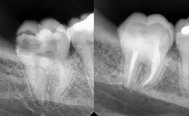 Можно ли делать снимок зуба. Конкрементозный пульпит. Конкрементозный пульпит рентген. Пульпит 17 зуба рентген с запломбированными каналами. Кариес пульпит периодонтит рентген.
