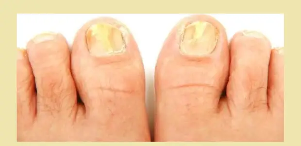 Грибковая эпидермофития ногтей на пальцах ног