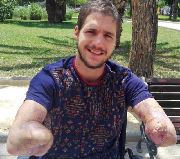 24-летний спортсмен лишился рук и ног из-за врачебной ошибки