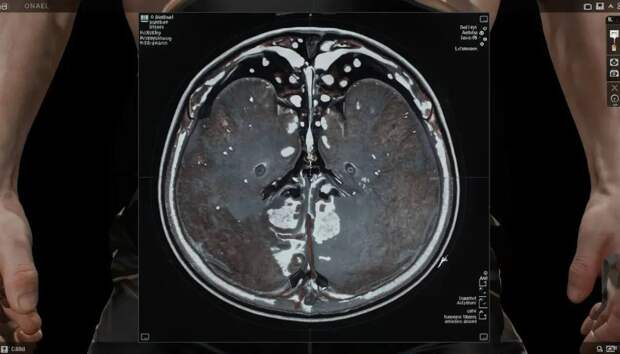 МРТ органов мошонки, тазовых и парааортальных лимфатических узлов: диагностика и клиническое значение