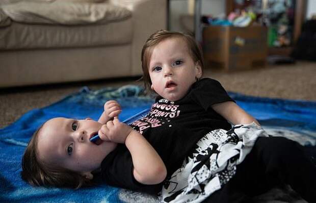 Сиамские близнецы не оправдали прогнозы врачей - живут уже второй год вместо отведенных им суток 