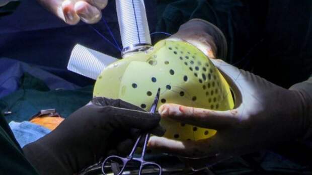 Первое полностью искусственное сердце успешно трансплантировано пациенту