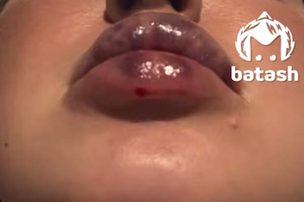 Россиянке изуродовали губы и обвинили ее в вымогательстве