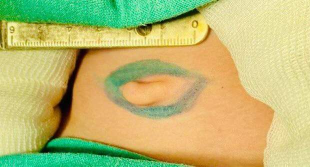 Подмосковные врачи прооперировали ребёнка с жабрами