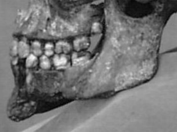 Нижняя челюсть Ольги Николаевны, на нижнем зубе (большом; этот зуб в стоматологии зовётся моляром или большим коренным зубом) вероятно пломба.