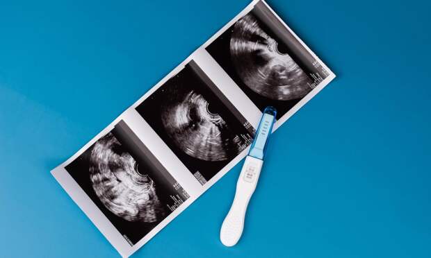 Что такое биохимическая беременность: признаки и возможные причины