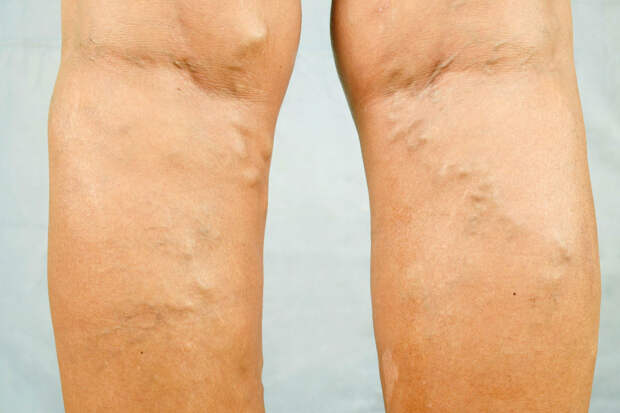 Врач Кондрахин: охлаждающие ванны помогают предотвратить развитие варикоза ног