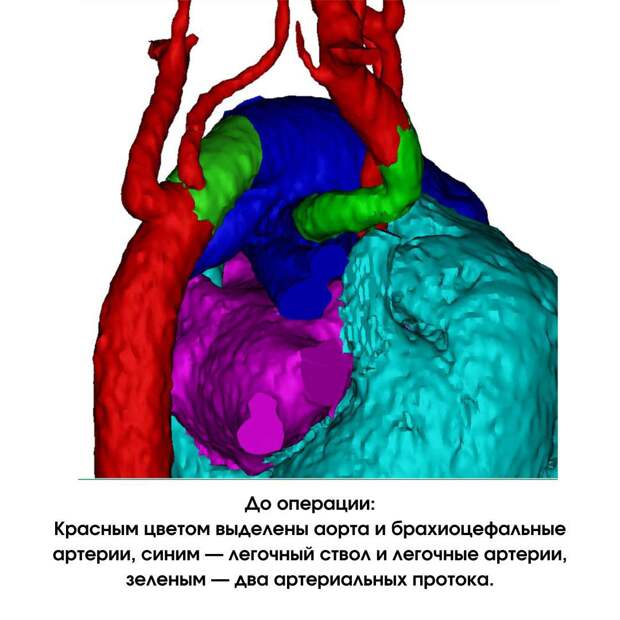 Критическую патологию развития плода у жительницы Марий Эл обнаружили на 23-й неделе беременности. УЗИ показало, что сердце ребенка развивается со множественными аномалиями. Прогнозы были крайне неблагоприятные, чреватые процедурой прерывания беременности, сообщили «Медицинской России». Семья обратилась в НМИЦ им. Е. Н. Мешалкина. Специалисты решились оперировать ребенка и сразу после рождения в Новосибирском перинатальном центре его перевели в Центр и обследовали. Были выявлены: