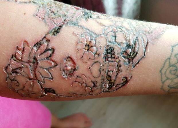 Невеста горько пожалела о решении удалить татуировку лазером перед свадьбой