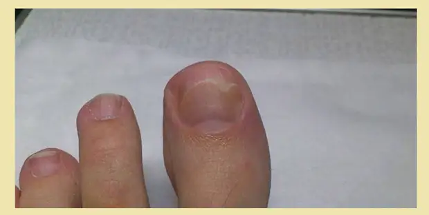 Грибковые патологии ногтей на большом и других пальцах ног