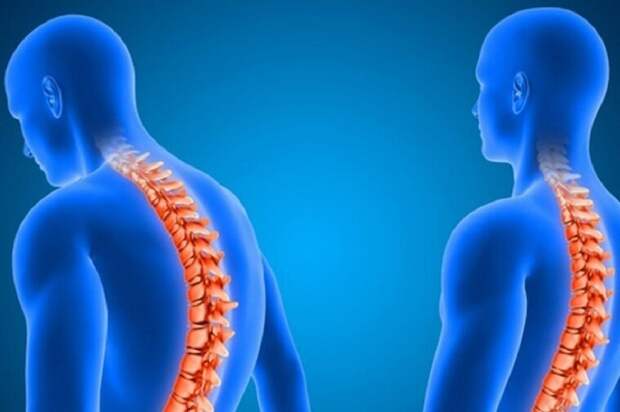 Кифоз позвоночника: причины возникновения и эффективные методы лечения