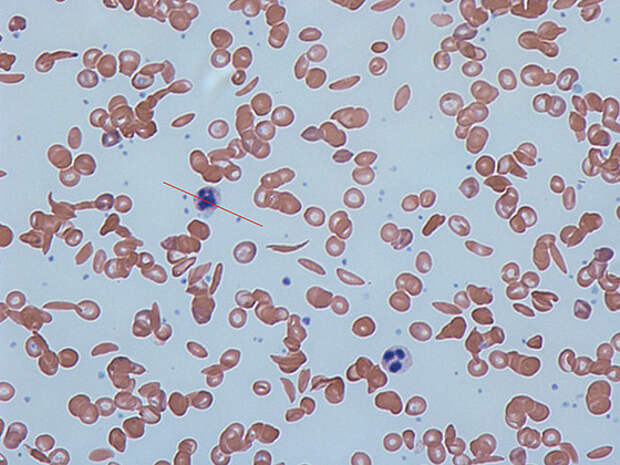 Изображение серповидных эритроцитов в крови человека среди нормальных кровяных клеток