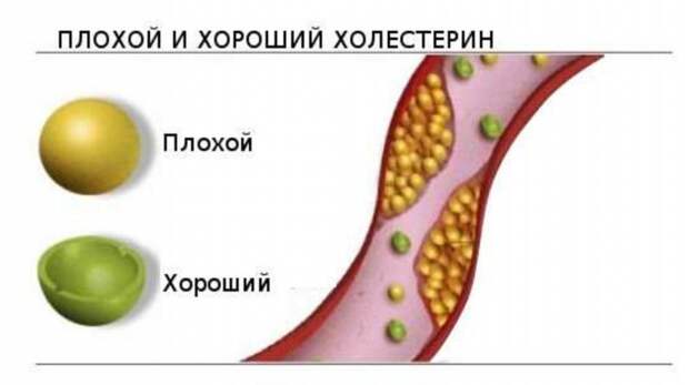 Липопротеиды — это… Классификация, норма и отклонения, причины повышения