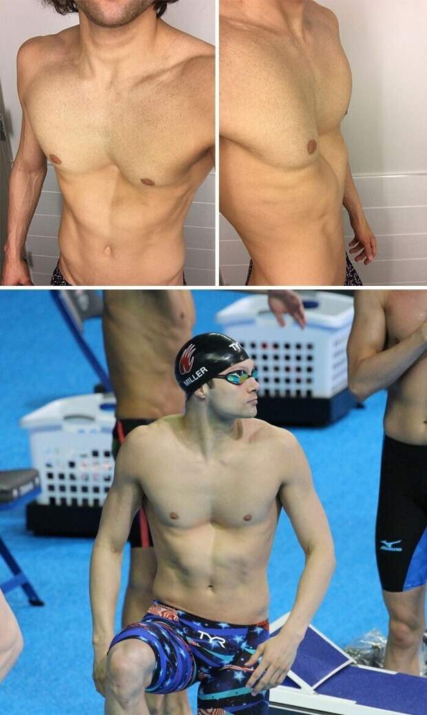 "У меня редкое заболевание, Pectus Excavatum. Из-за него, начиная с 10-летнего возраста, моя грудная клетка становилась все более впалой. Но плавать это не мешает"