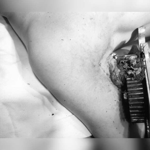 В ГБУЗ МО «Каширская центральная районная больница» поступила 25-летняя пациентка с обширной раной в области бицепса. Как выяснилось, девушка работала с зернодробильной машиной, когда её одежду вместе с рукой затянуло в движущийся механизм, который повредил мягкие ткани и мышцы плеча. Деталь от техники вошла практически до плечевой кости. Врачи экстренно прооперировали пациентку.