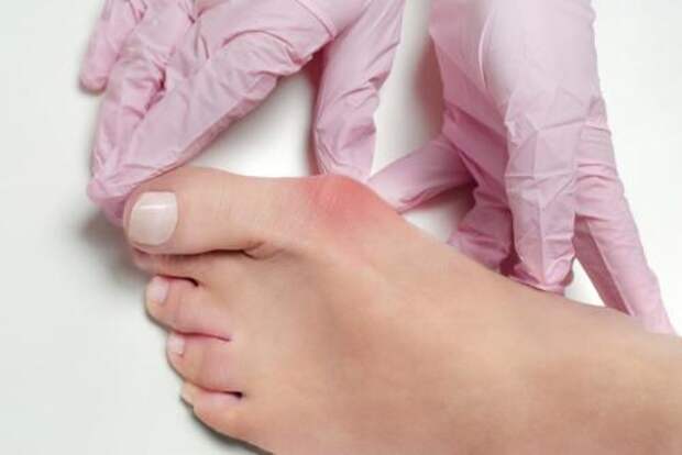 Какие бывают шишки на пальцах ног. Возможные диагнозы – причины того, что на стопе вылезла шишка