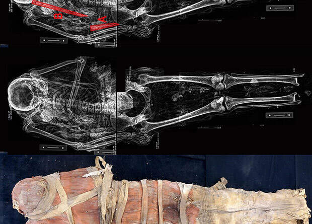 В Египте нашли мумию парализованной после инсульта женщины