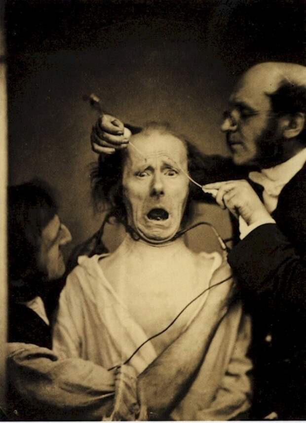 Дюшен де Булонь изучает влияние электричества на нервы. Франция, 1862 год.