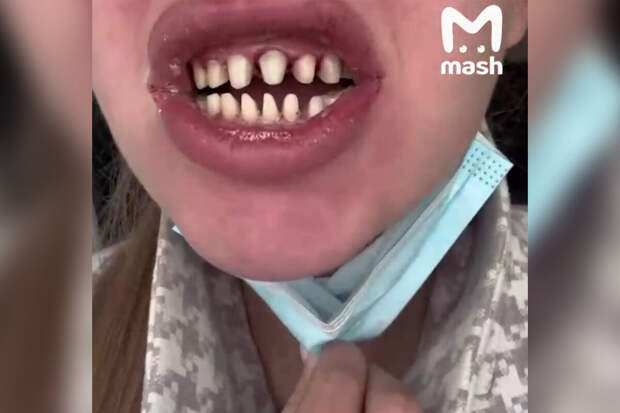 Блогерша из Иркутска отдала миллионы ради красивой улыбки, но осталась без зубов