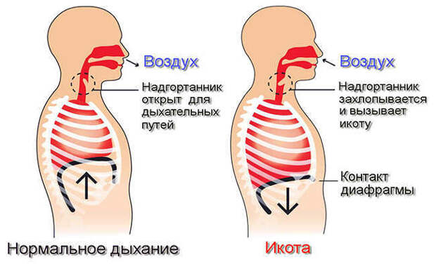 100% быстрое избавление от икоты икота, избавление
