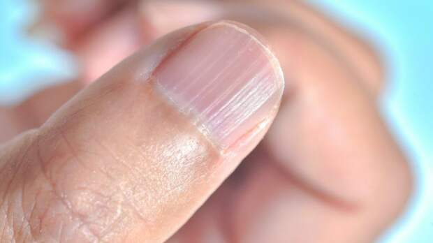 5 распространенных дефектов ногтевой пластины, которые часто ошибочно принимают за косметические