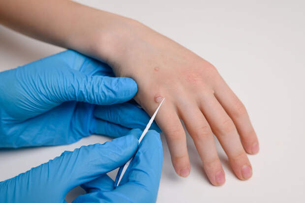 Онколог Шевчук: с ВПЧ, который может вызывать рак, сталкивались до 95% россиян