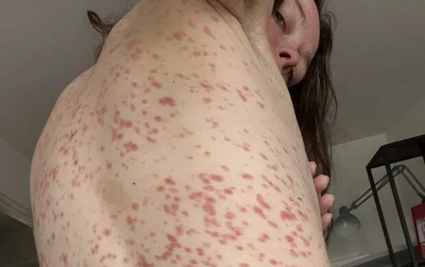 Поддержка встревоженного партнера помогла девушке добиться помощи игнорировавших ее врачей