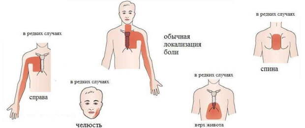 Стенокардия: простые домашние рецепты лечения. Как избежать приступа стенокардии, признаки болезни