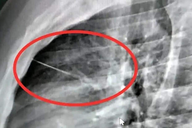 В Таиланде забытая на кровати игла едва не пронзила сердце мужчины