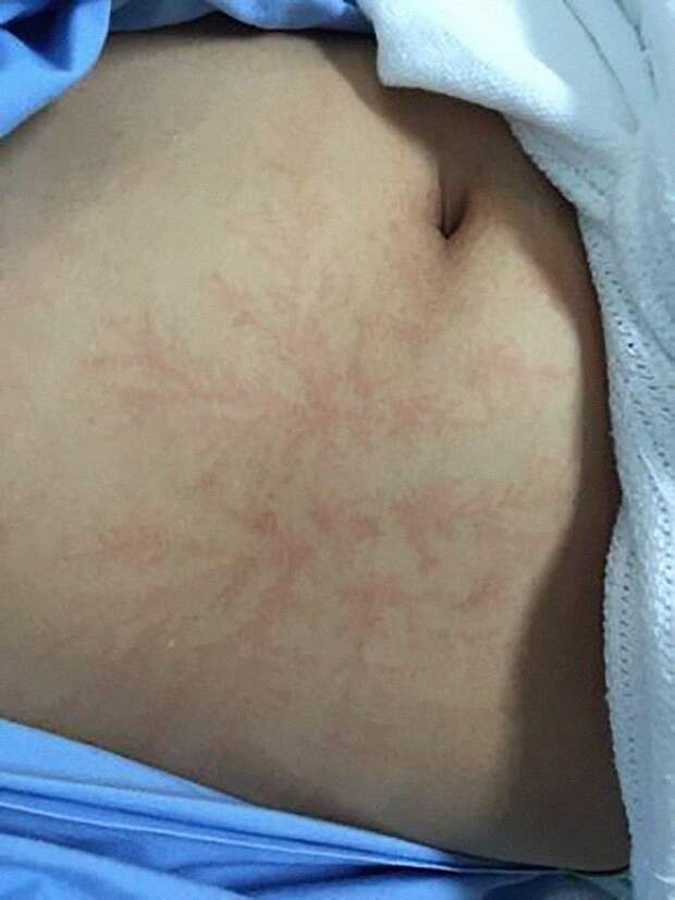 Что бывает после удара молнией