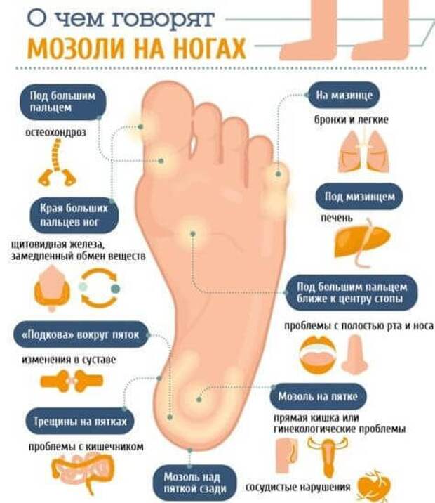 О чём расскажут мозоли на ногах