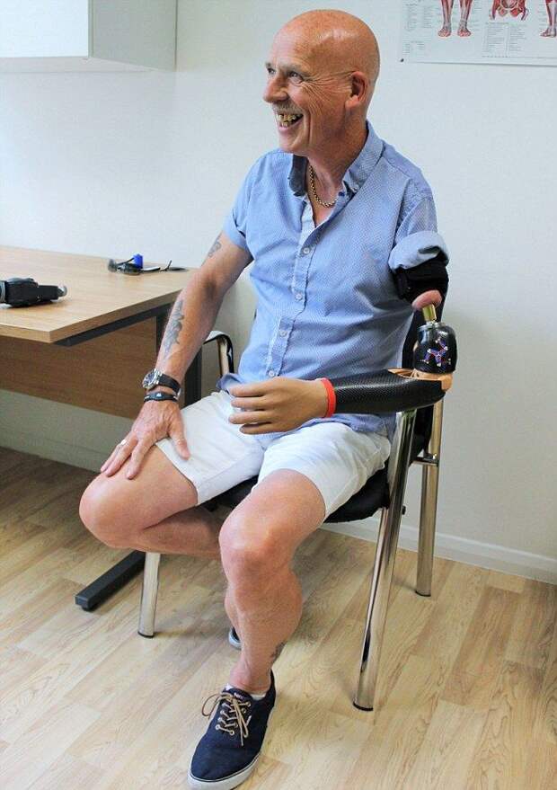 57-летнему британцу вживили бионический протез с кучей насадок