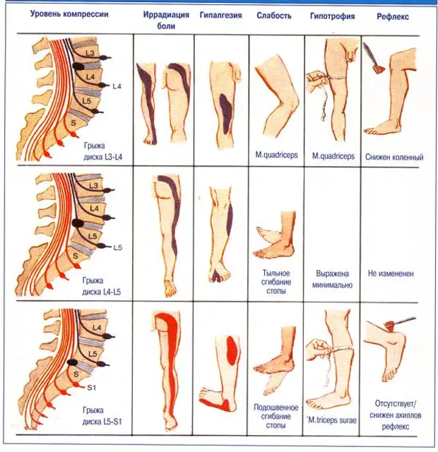 Боль в ногах и пояснице причины. Радикулопатия s1 корешка. Позвоночник ноги.