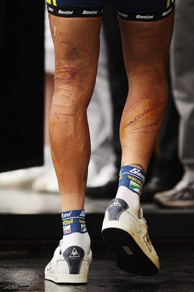 5. Ноги велосипедистов после долгих заездов интересно, победы, спортсмены, травмы в спорте, фото