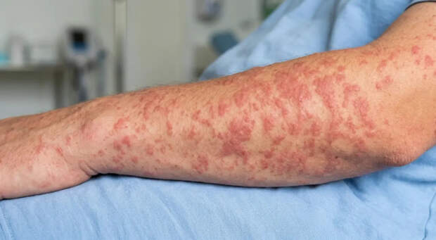 Во Владимирской области у двоих подмосковных школьников выявили корь