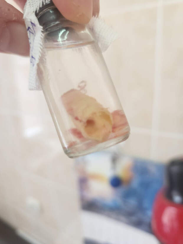 Смоленские нейрохирурги спасли от смерти мужчину с тромбом