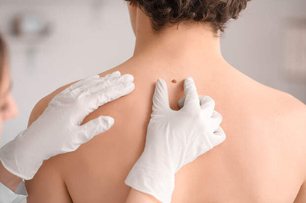 Врач Егорова: красные родинки не представляют опасности