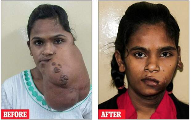 Индийская девочка улыбнулась впервые за 14 лет после того, как хирурги удалили опухоль с ее лица индия, медицина, опухоль, пластическая хирургия